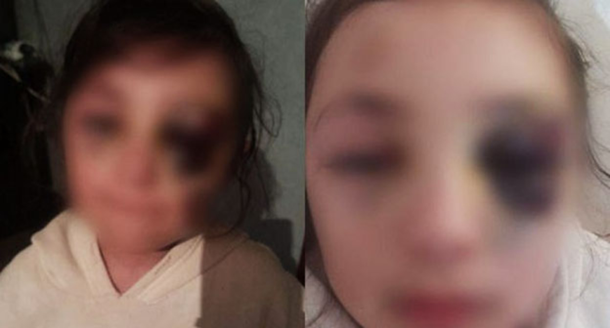 Девочка, получившая травму лица в школе. Фото: https://media.az/society/1067937627/mat-poluchivshey-v-shkole-travmu-uchenicy-oni-dazhe-ne-prilozhili-led-k-gematome-video/ Девочка, получившая травму лица в школе. Фото: https://media.az/society/1067937627/mat-poluchivshey-v-shkole-travmu-uchenicy-oni-dazhe-ne-prilozhili-led-k-gematome-video/
